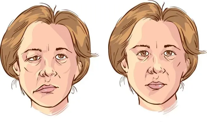 Bell’s Palsy – Separuh Muka Jatuh