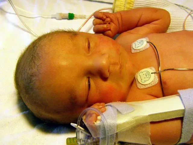 Apa itu Jaundice Dan Kenapa Ada Orang Menjemur Bayi?