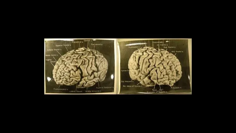 Otak Einstein Pernah Dicuri Ketika Kematiannya