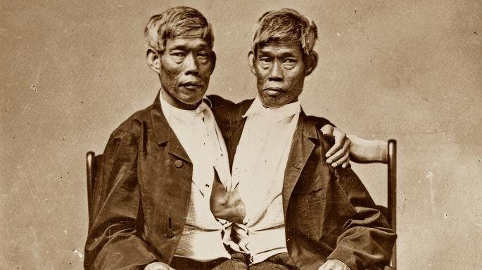 Kembar Siam Pertama Dunia Memang Berasal Dari Siam?